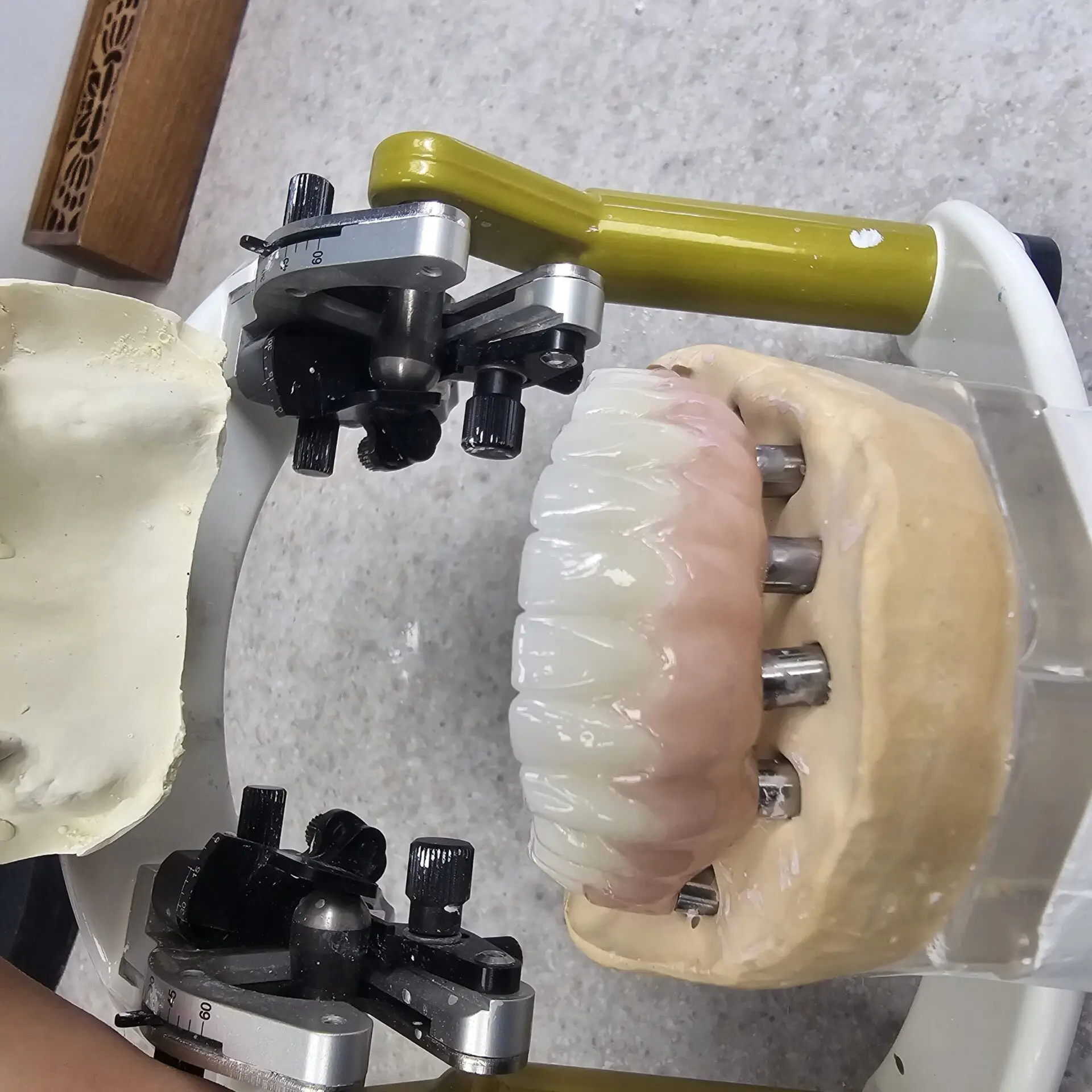 Dental Crowns Gallery in London Ontario Ultra Dental Lab