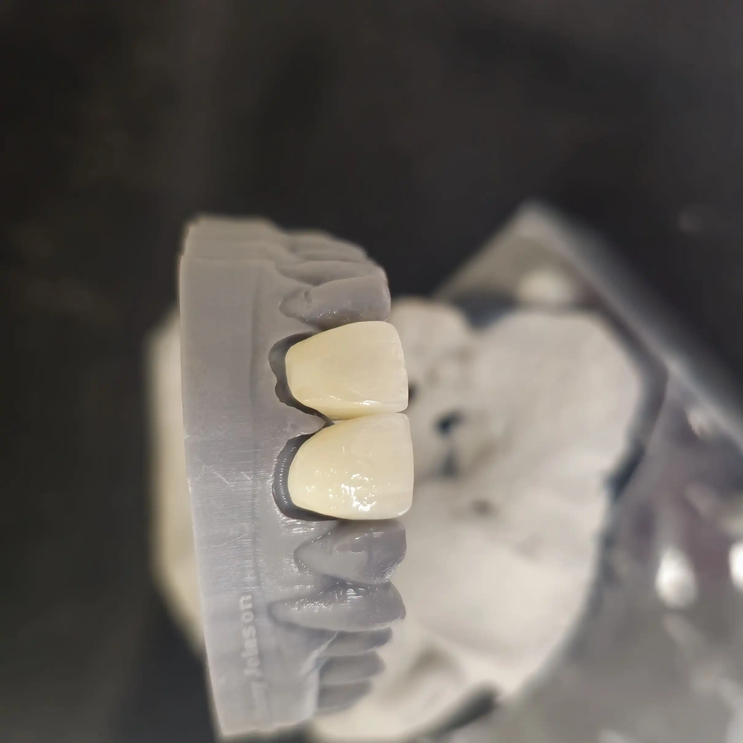 Dental Crowns Gallery in London Ontario Ultra Dental Lab